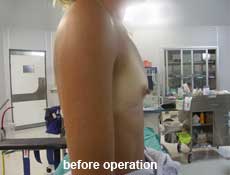plastic-surgery-breast-augmentation 